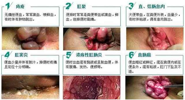 引起便血原因.jpg