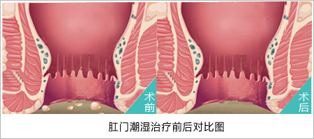 肛门潮湿前后.jpg