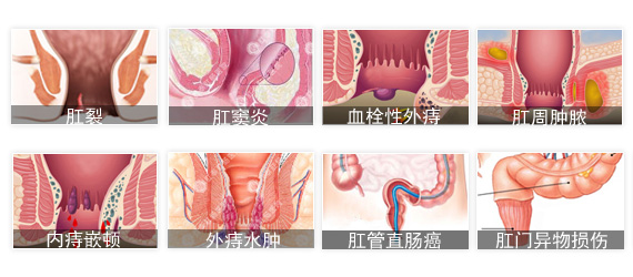肛门疼痛图片.jpg