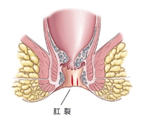 （A1)视诊，肛肠医院患者，男性，43岁，肛门6点位置陈旧性肛裂伴有外痔，我院一次治疗后10天康复.jpg