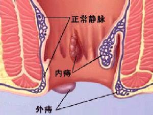 痔疮j.jpg